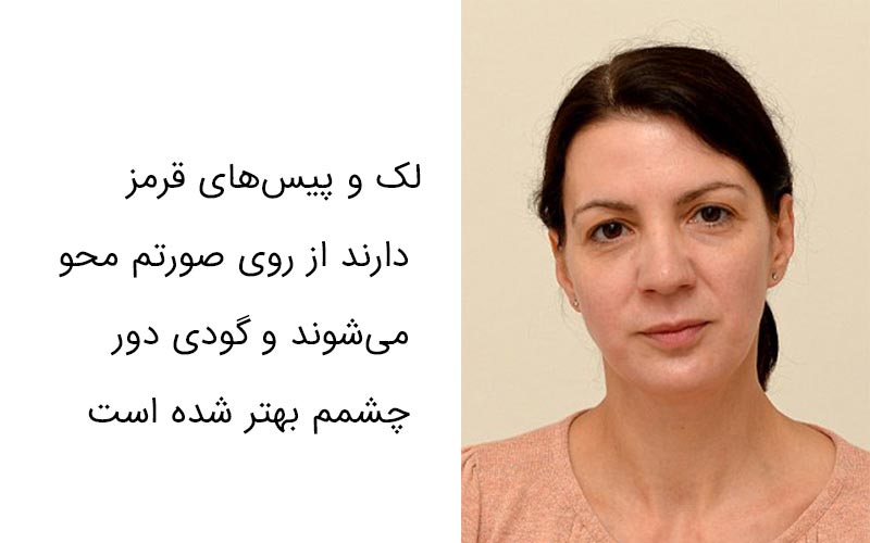 هفته دوم جوان شدن پوست