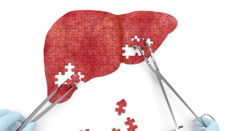 درمان کبد چرب