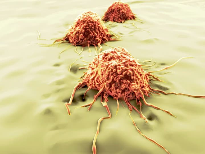 متاستاز یا گسترش سلولهای سرطانی از عوارض سرطان ریه است.