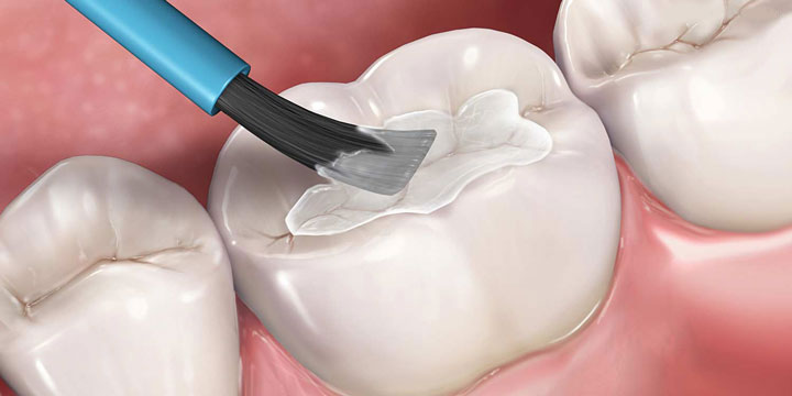 جلوگیری از پوسیدگی دندان با استفاده از روکش محافظ دندان
