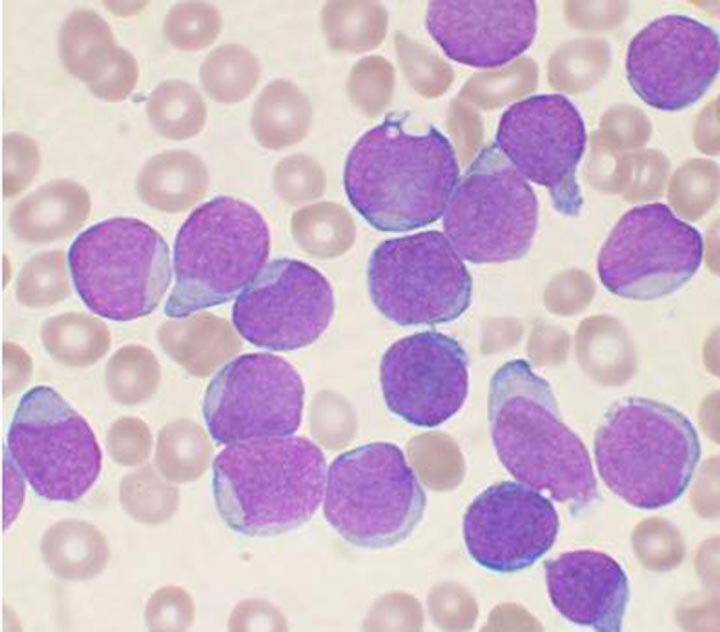 لوسمی لنفوتیک حاد - علائم سرطان خون