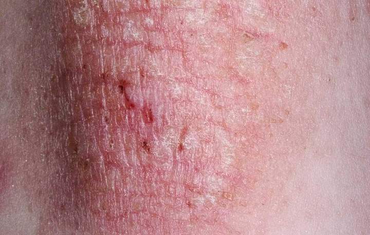 [عکس: eczema.jpg]
