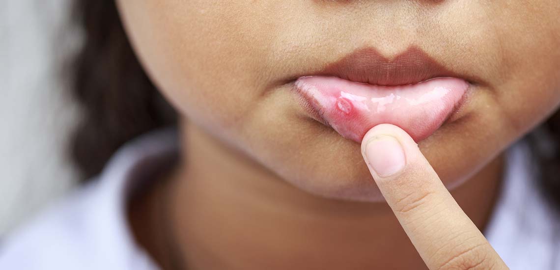 درمان آفت دهان با ۲۰ روش آسان خانگی