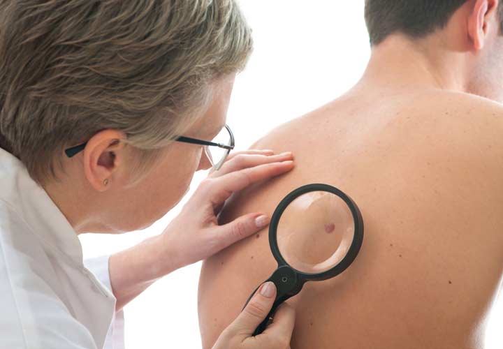کرایوسرجری، خشک کردن الکتریکی و کورتاژ، کرم و جراحی اکسیژنال از درمانهای سرطان پوست هستند. علائم سرطان پوست