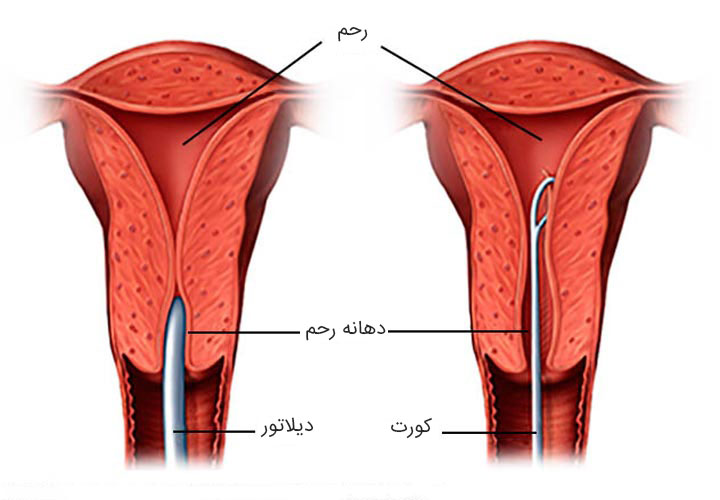 کورتاژ چیست