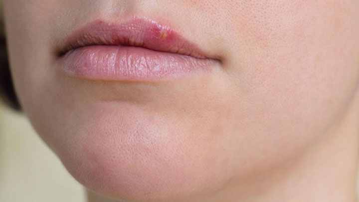 برای درمان تبخال باید انواع ویروس های آن را بشناسیم