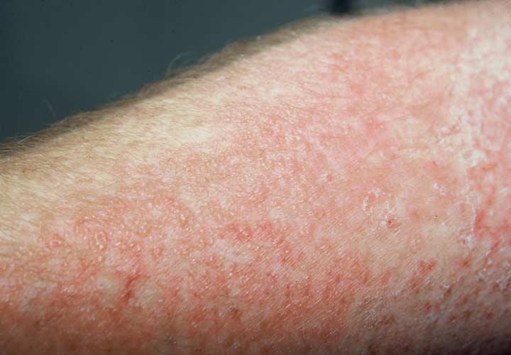 خواص سیاه دانه - یکی از عوارض جانبی بالقوه سیاه دانه بروز درماتیت تماسی است.
