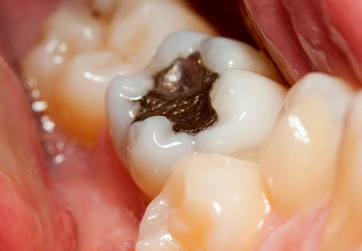 درمان دندان درد - اگر پوسیدگی دندان به عصب برسد از پرکردن استفاده می کنند.