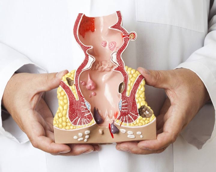 درمان بیماری های مقعد، شقاق، فیستول، کیست مویی، بواسیر (هموروئید)