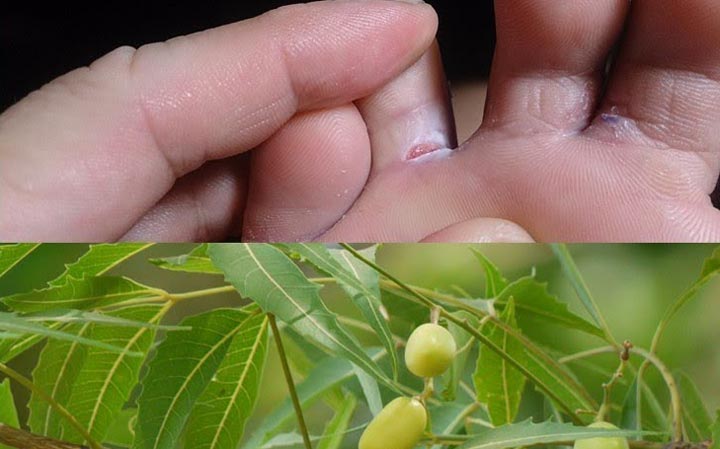 روغن درخت چای - درمان پای ورزشکاران