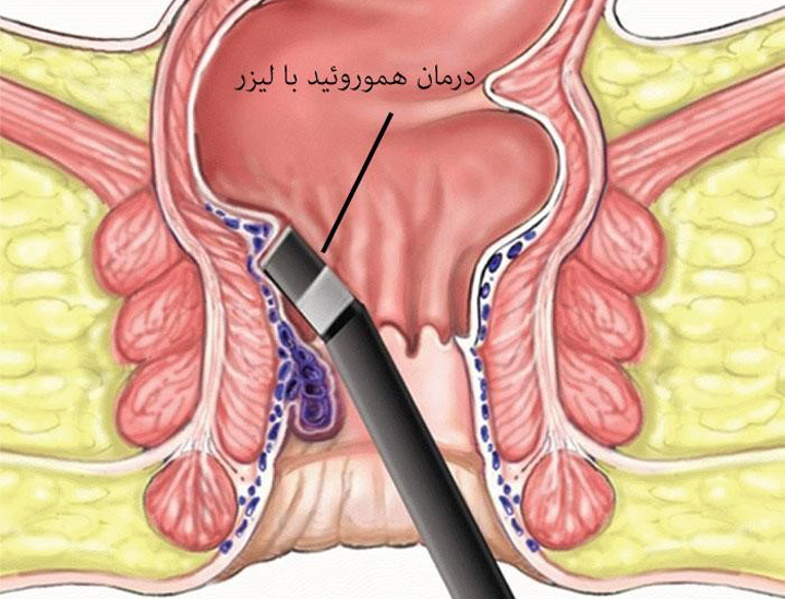 هموروئید یا بواسیر