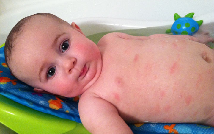 اسهال نوزاد - آلرژی شدید در نوزاد ممکن است سبب کهیر شود