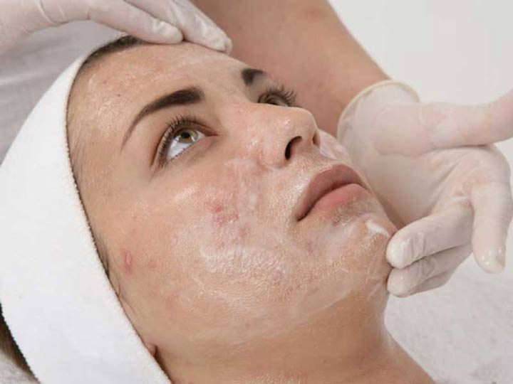 لایه برداری شیمیایی برای جوش چانه