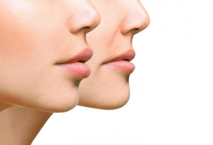 مزایای فیلرهای پروتر لب