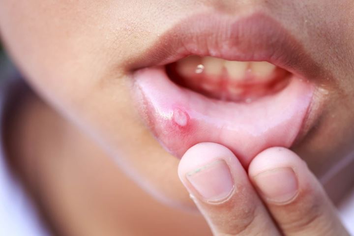 خواص شیرین بیان - کمک به درمان آفت دهان