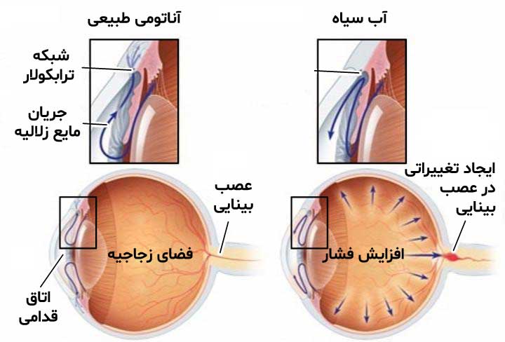علت ابتلا به آب سیاه
