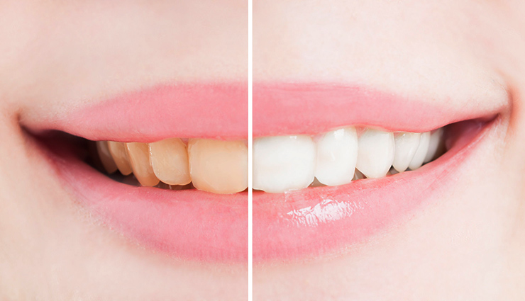 بلیچ دندان توسط پزشک و روش‌های سفید کردن دندان در خانه