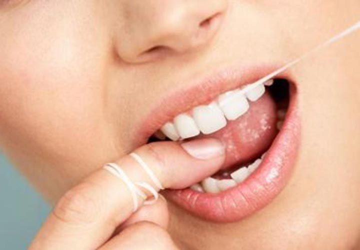 رعایت بهداشت دهان مانن مسواک زدن و نخ دندان از راه های کاهش خطر بروز سنگ لوزه است.