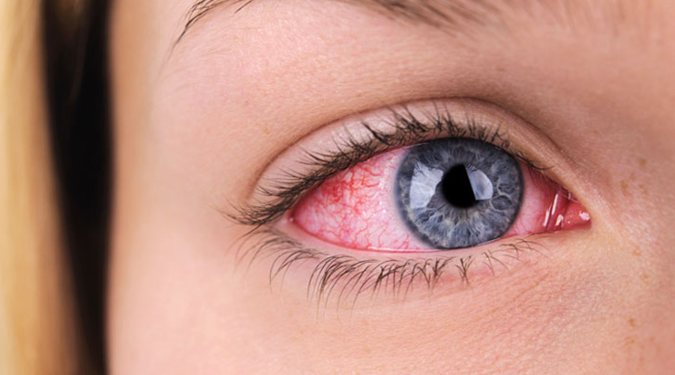 علت قرمزی چشم و راه‌های درمان آن