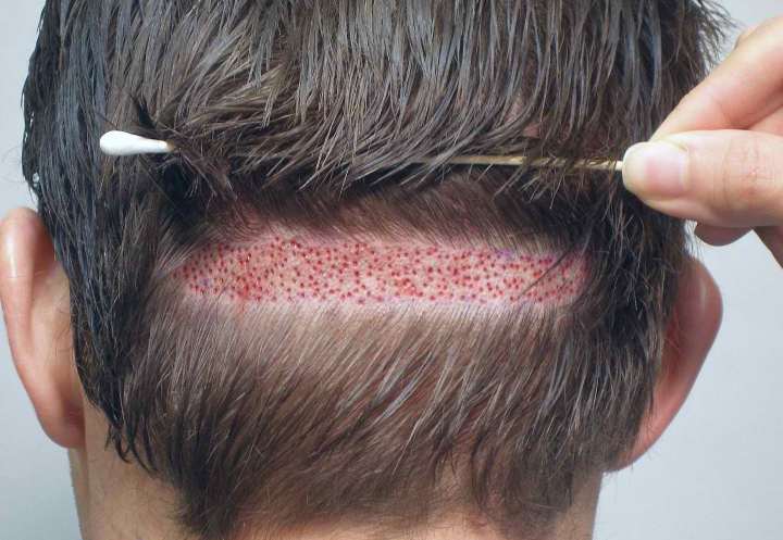 جراحی پیوند مو برای درمان ریزش مو