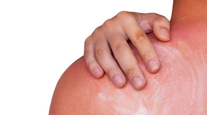 آفتاب سوختگی و خارش سینه