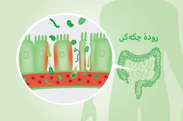 سندروم روده نشت کننده یا چکه کن