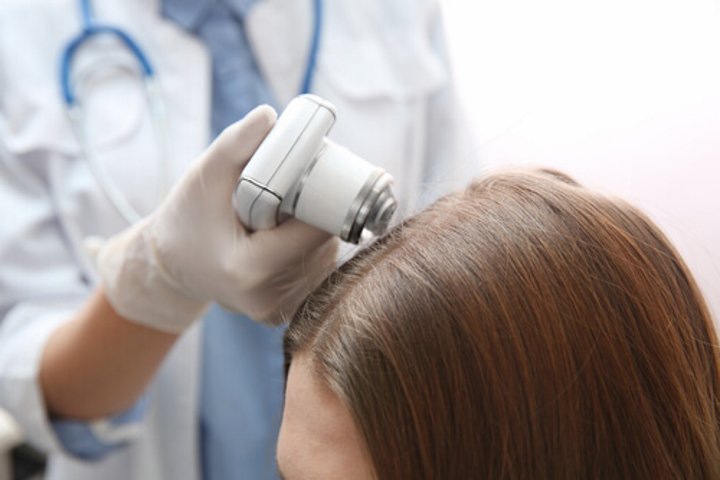 نمونه برداری از پوست سر برای تشخیص علت و درمان ریزش مو