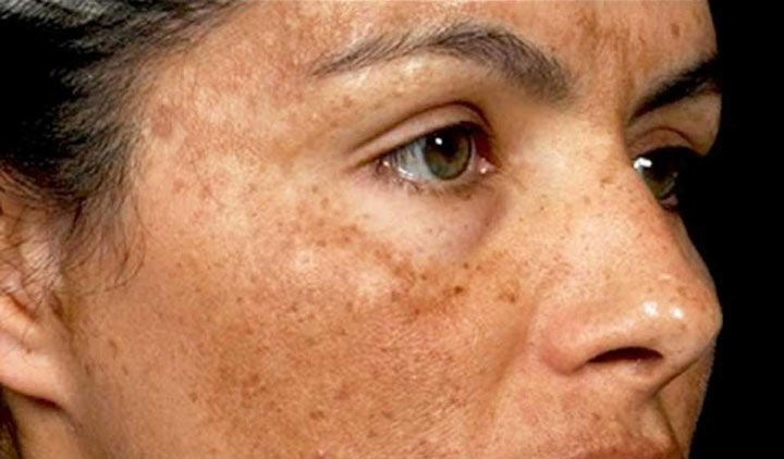 ااز بین بردن لکه های قهوه ای پوست - تولید بیش از اندازه ملانین باعث به وجود آمدن لکه های تیره روی پوست می‌شود