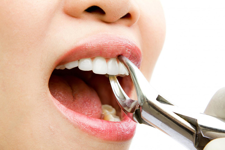 کشیدن دندان - هزینه خدمات دندانپزشکی