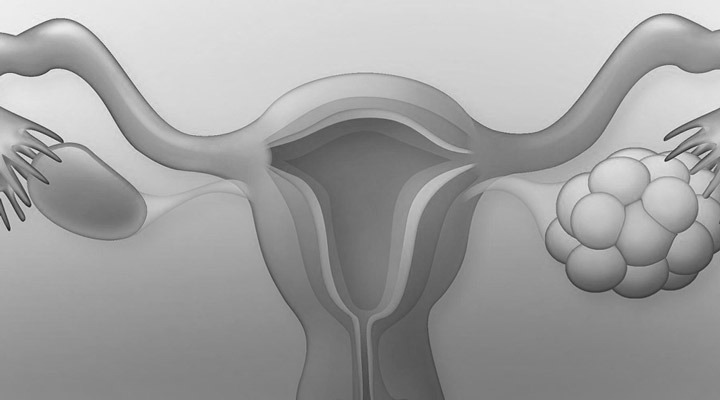 سندرم تخمدان پلی کیستیک می تواند بر چرخه قاعدگی اثر بگذارد