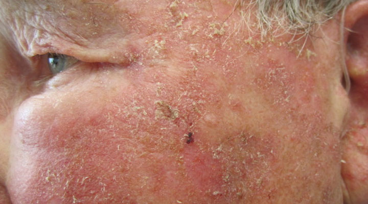 آکتینیک یکی از شایع ترین مشکلات پوستی است