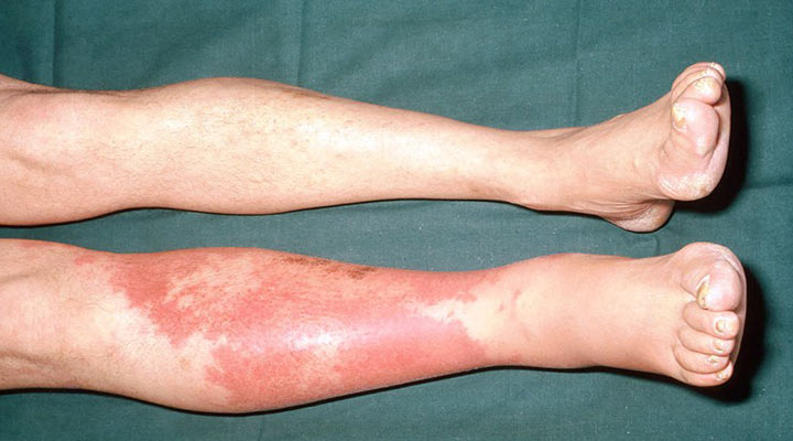 سلولیت یکی از شایع ترین مشکلات پوستی است