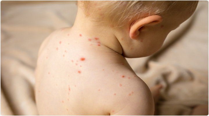 سرخک یکی از شایع ترین مشکلات پوستی است