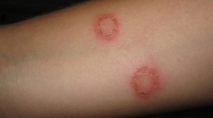 عفونت قارچی حلقه‌ای یکی از شایع ترین مشکلات پوستی است