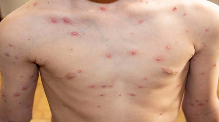 آبله مرغان یکی از شایع ترین مشکلات پوستی است
