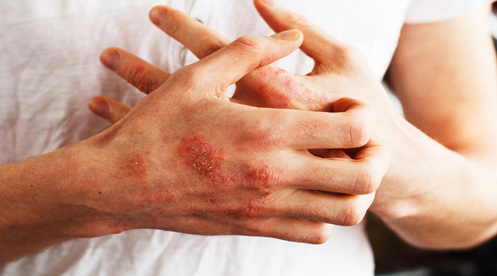 اگزما یکی از شایع ترین مشکلات پوستی است
