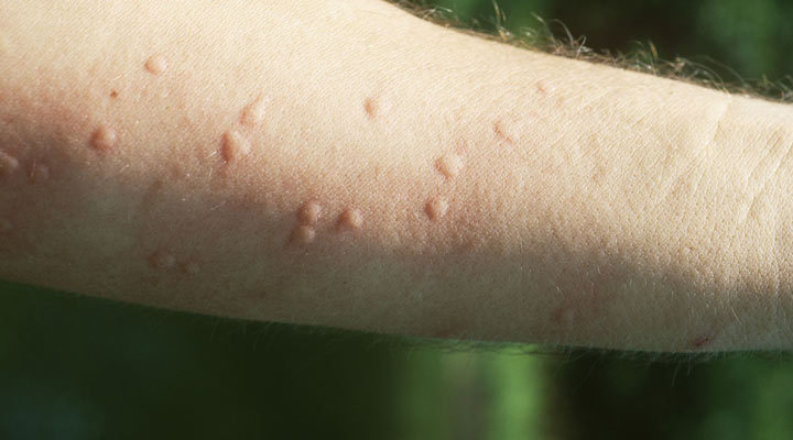 کهیر یکی از شایع ترین مشکلات پوستی است