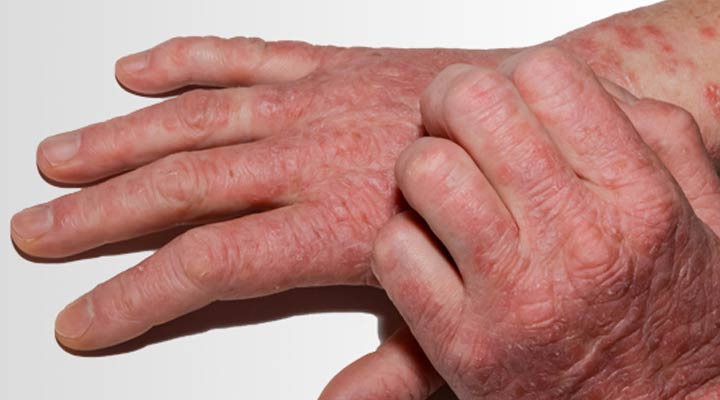 آلرژی به لاتکس یکی از مشکلات شایع پوستی است
