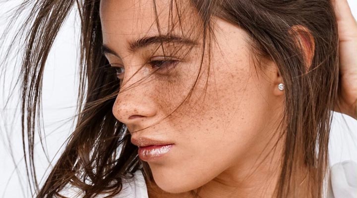 ملاسما یکی از شایع ترین مشکلات پوستی است
