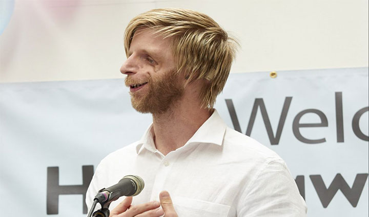 جونو لانکستر (Jono Lancaster) مبتلا به سندروم تریچر کالینز