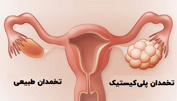 دلایل سقط جنین - سندروم تخمدان پلی کیستیک