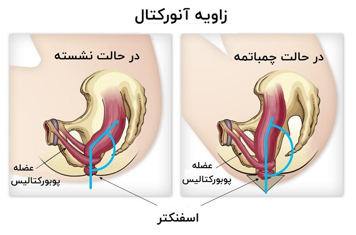 توالت ایرانی یا فرنگی - زاویه آنورکتال در وضعیت چمباتمه بیشتر باز می شود