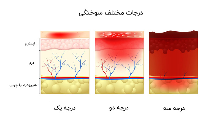 انواع سوختگی - درجات مختلف سوختگی