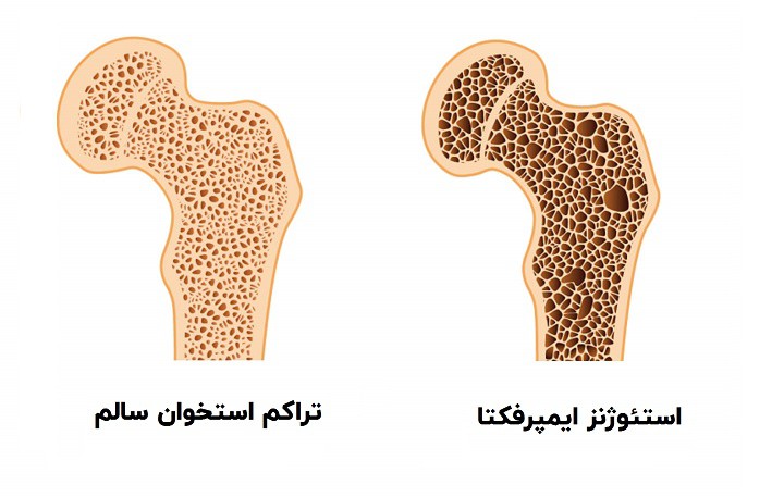 استئوژنز ایمپرفکتا از بیماری‌های استخوان