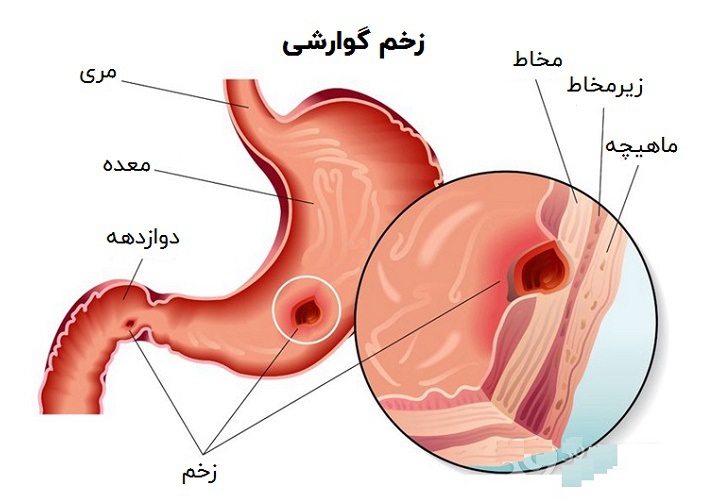 سندرم زولینگر الیسون و زخم های گوارشی