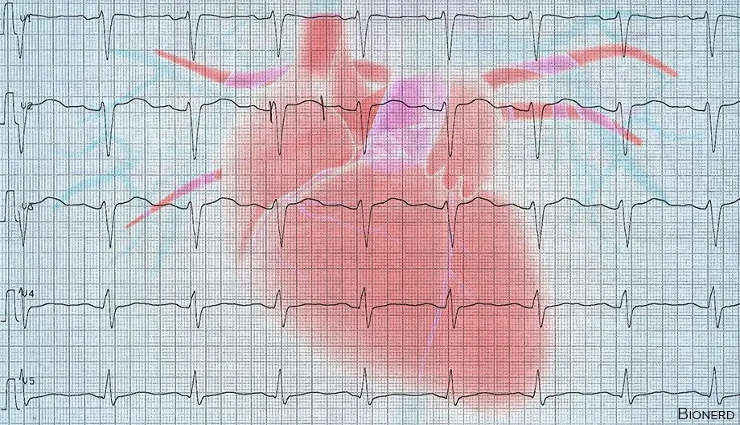 سندرم کیوتی طولانی قلب چیست