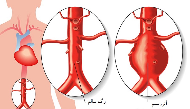 آنوریسم در برابر رگ سالم؛ روش تشخیص و درمان