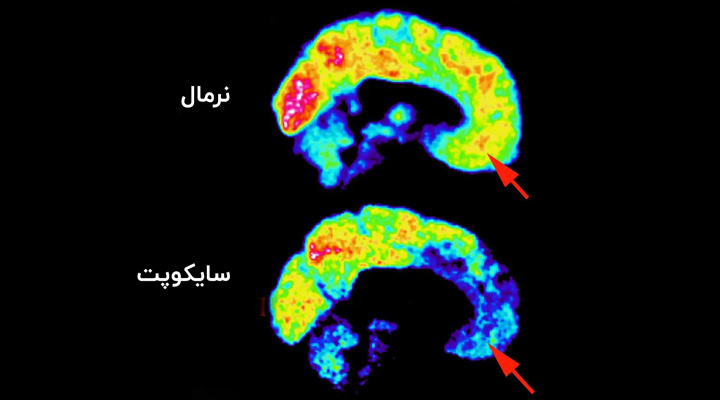 سایکوپت - تفاوت مغز سایکوپت با افراد عادی