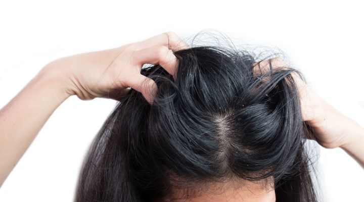 عوارض جانبی ماینوکسیدیل