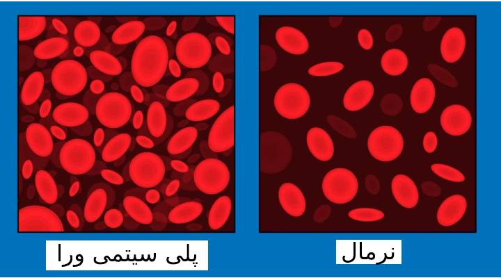بیماری پلی سیتمی ورا یکی از علت‌های غلظت خون